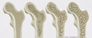 Die vier Stadien der Osteporose - Calcium hilft